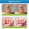 Toenail Fûngus Treatment Extra Strength, Nail Fûngus Treatment for Toenail & Fingernails, Nail Repair Solution for Thick Cracked Discolored Nails, Restore Healthy Nails
