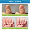Picture of Toenail Fûngus Treatment, Nail Repair Liquid for Toenail and Fingernail, Restore Healthy Nails