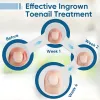 Picture of Ingrown Toenail Treatment, 30ml