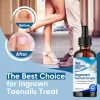 Picture of Ingrown Toenail Treatment, 30ml